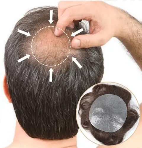 Crown hair patch
